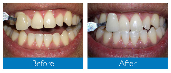 Teeth Whitening